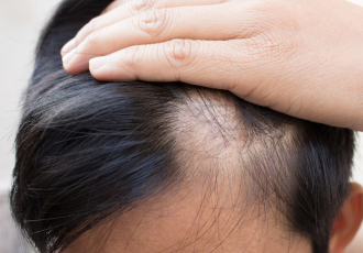 Mesotherapy (Targeted Scalp Nutrition)