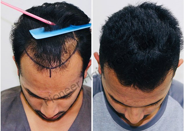 Hair Transplantation (FUE/FUT as indicated)